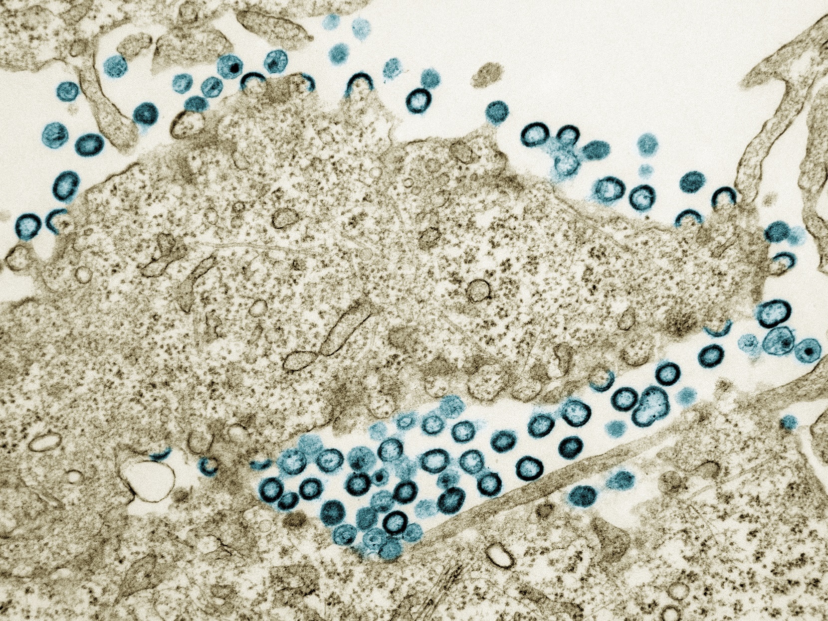 dans-une-etude-mondiale-a-grande-echelle,-une-analyse-exploratoire-revele-que-l’abacavir-augmente-le-risque-de-maladie-cardiovasculaire-dans-un-essai-a-grande-echelle