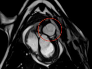 une-valve-cardiaque-en-collagene-pourrait-ameliorer-la-prise-en-charge-des-« enfants-bleus »
