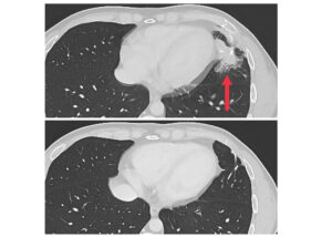 some-people-with-metastatic-cancers-could-benefit-from-immunotherapy