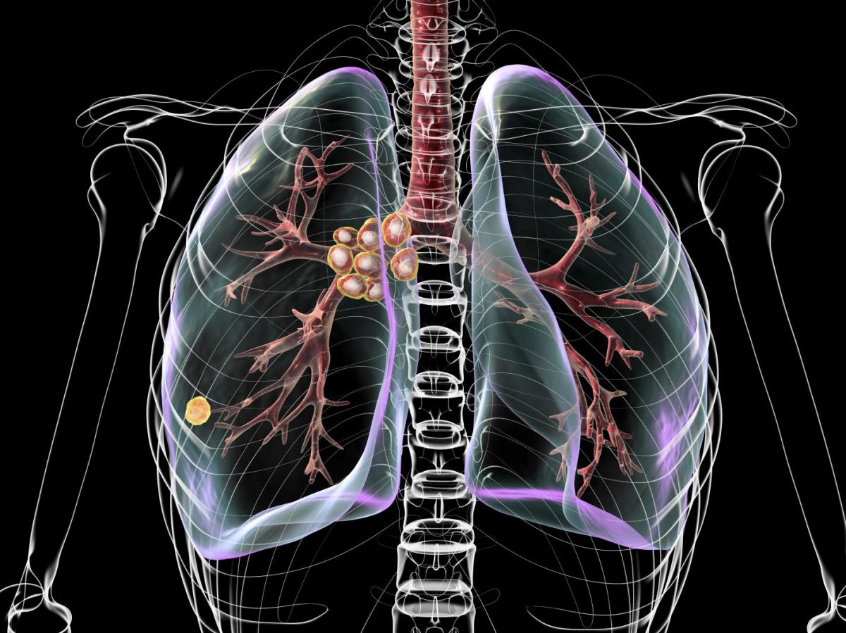 a-new-tool-emerges-to-detect-tuberculosis-with-precision