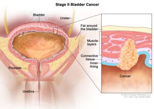 apres-la-chirurgie,-l’immunotherapie-aide-les-patients-atteints-d’un-cancer-de-la-vessie-a-haut-risque-a-vivre-plus-longtemps-sans-cancer