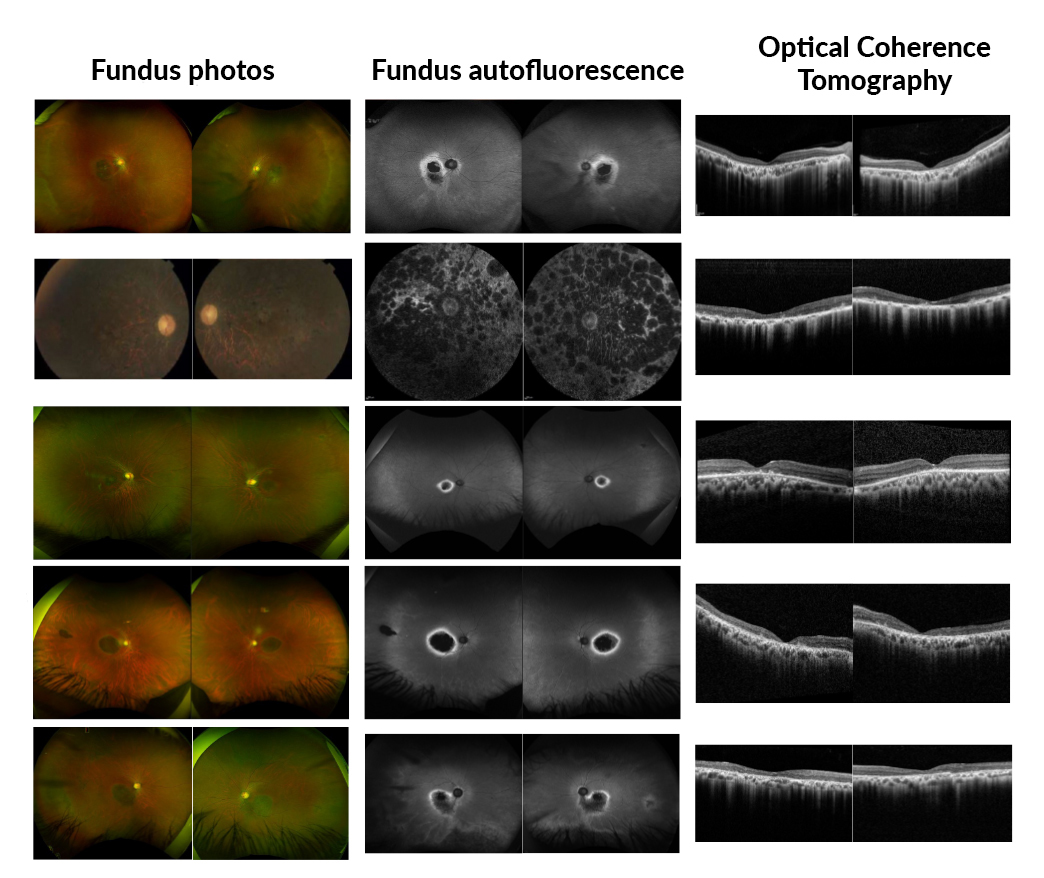 des-scientifiques-decouvrent-le-gene-responsable-d’une-maladie-oculaire-rare-et-hereditaire