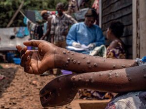 mpox-:-la-crainte-d’une-nouvelle-pandemie