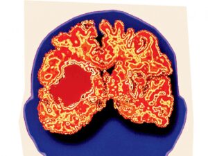 avc-hemorragique-:-juguler-au-plus-tot-l’hematome