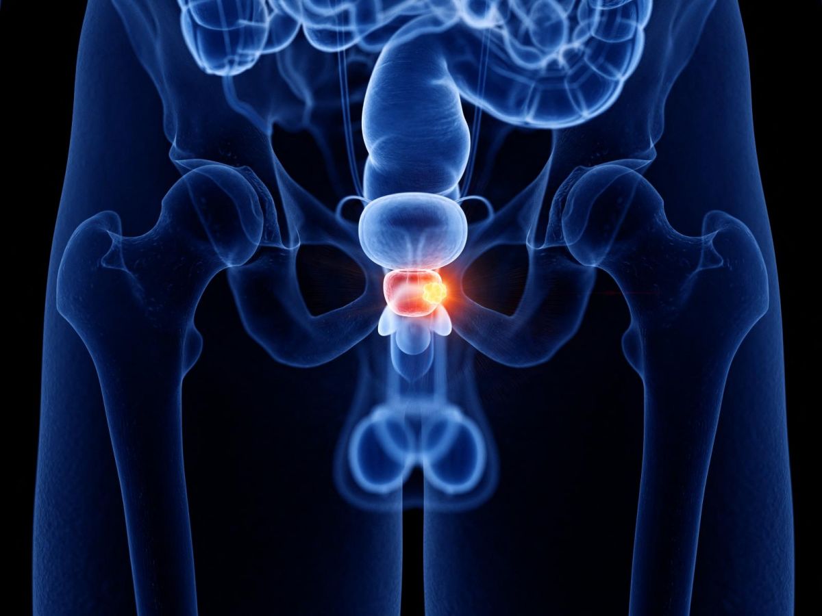 prostate-cancer-a-new-achilles-heel-discovered!