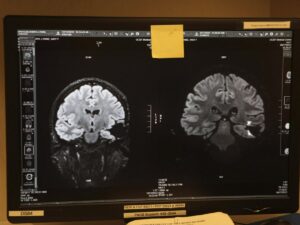 brain-tumor-:-car-t-cells-could-even-prevent-recurrences