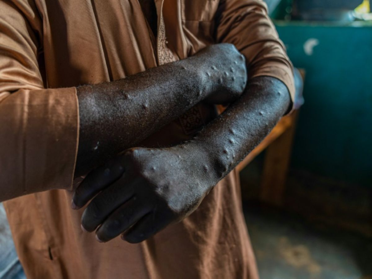 mpox-en-france-:-un-premier-cas-du-nouveau-variant-identifie-en-bretagne