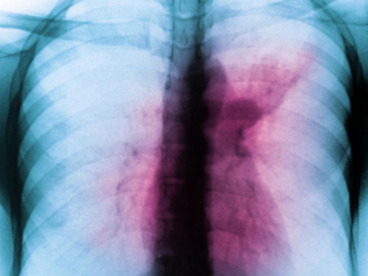 Could tuberculosis become a global threat again?