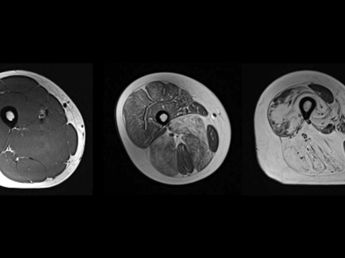 video.-neuromuscular-diseases-under-imaging