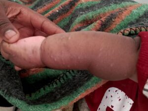 New strain of MPOX could increase risk of miscarriage