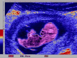 "Eternal Pollutants": Do PFAS Affect Placental Health and Fetal Development?