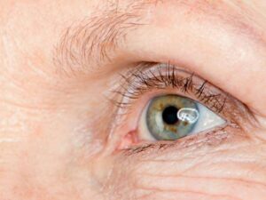 eye diseases: protective vitamins