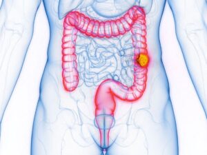 cancer-colorectal-chez-les-jeunes-:-une-piste-enfin-identifiee
