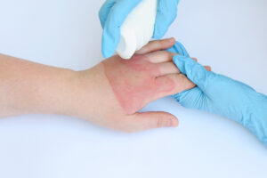 une-etude-du-nih-revele-comment-l’inflammation-rend-le-toucher-douloureux
