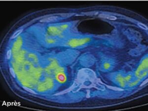 cancer-:-les-nouvelles-armes-de-l’immunotherapie