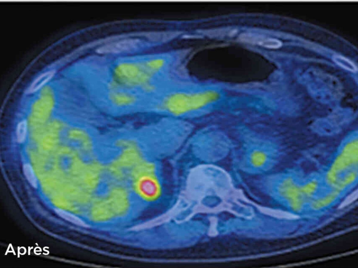 cancer: the new weapons of immunotherapy