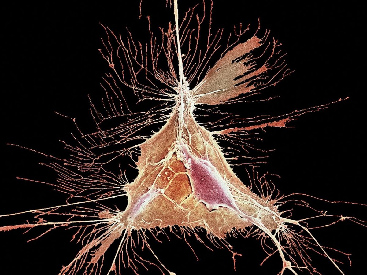 multiple sclerosis: neural stem cell transplant to repair nerve fibers