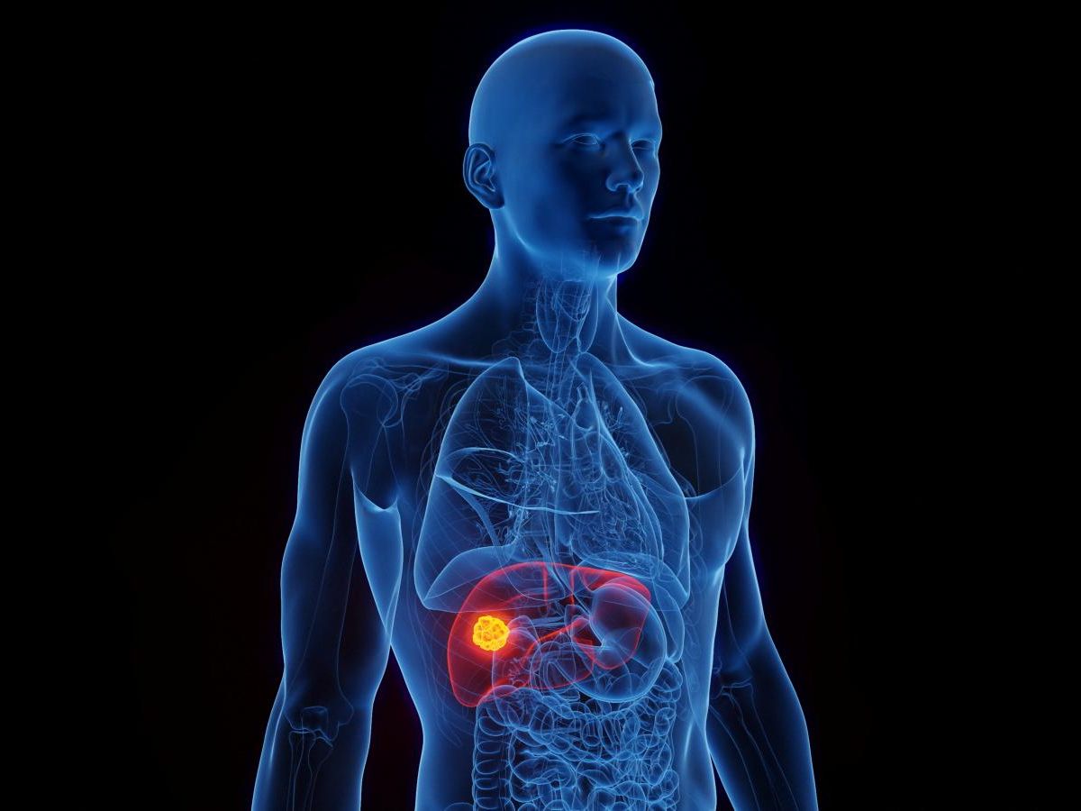 comment-eviter-l’explosion-mondiale-des-cas-de-cancers-du-foie-attendue-d’ici-2050