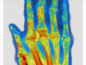 vers-un-implant-pour-soigner-la-polyarthrite-rhumatoide-?
