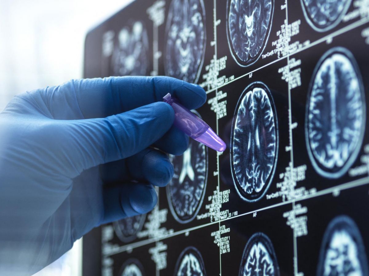 France says no to Leqembi treatment for Alzheimer's: "We are extremely disappointed"