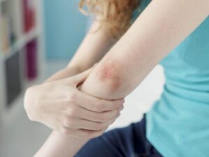 psoriasis-et-dmla-:-le-lien-confirme-par-une-etude