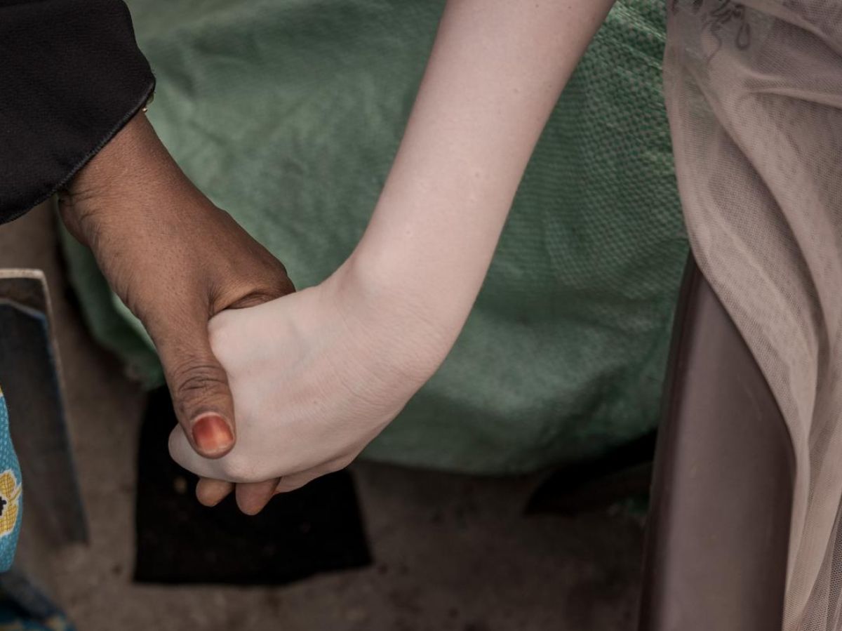 from dark to very light, this gene modulates skin color... up to albinism
