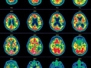 l’amnesie,-un-trouble-aux-multiples-causes