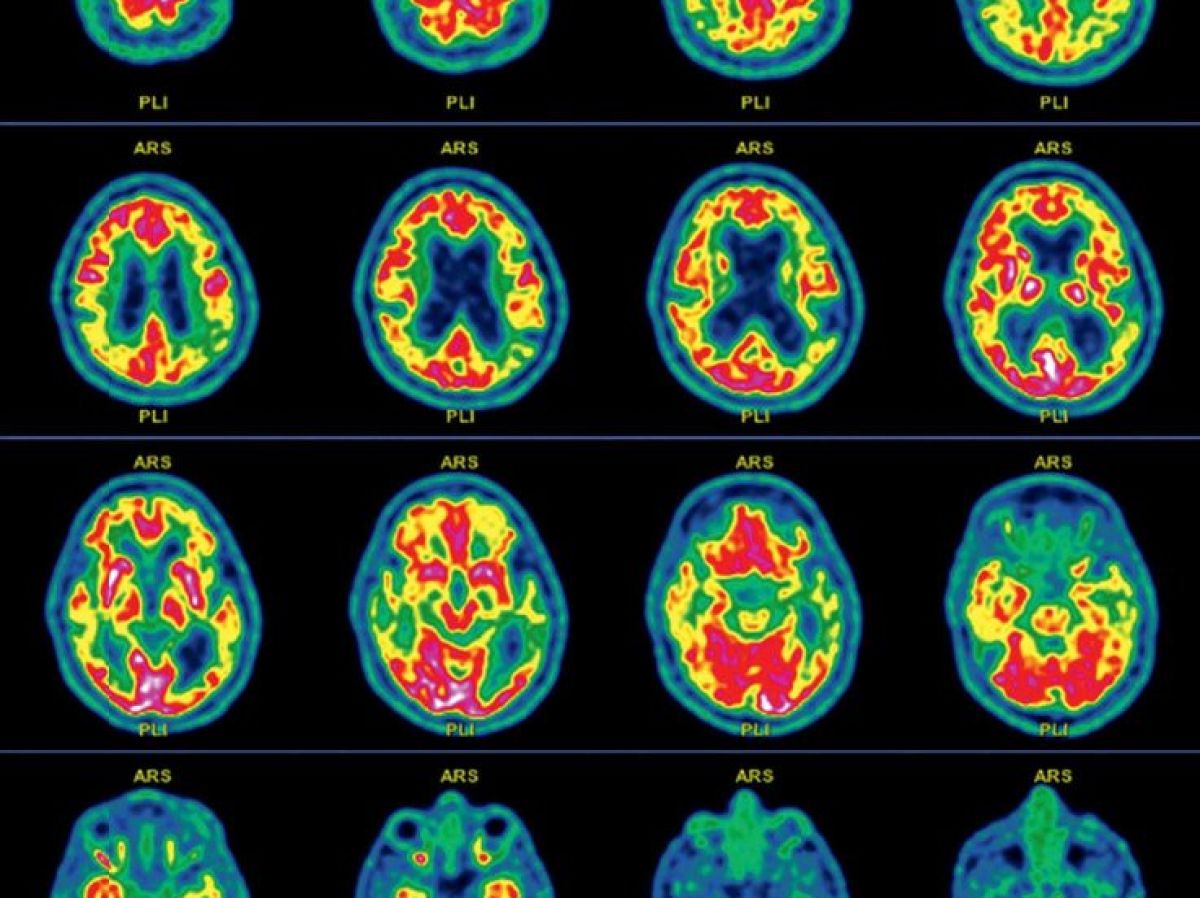 l’amnesie,-un-trouble-aux-multiples-causes