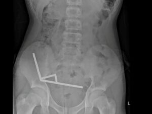 Teenager undergoes surgery after ingesting nearly 100 magnets purchased on Temu