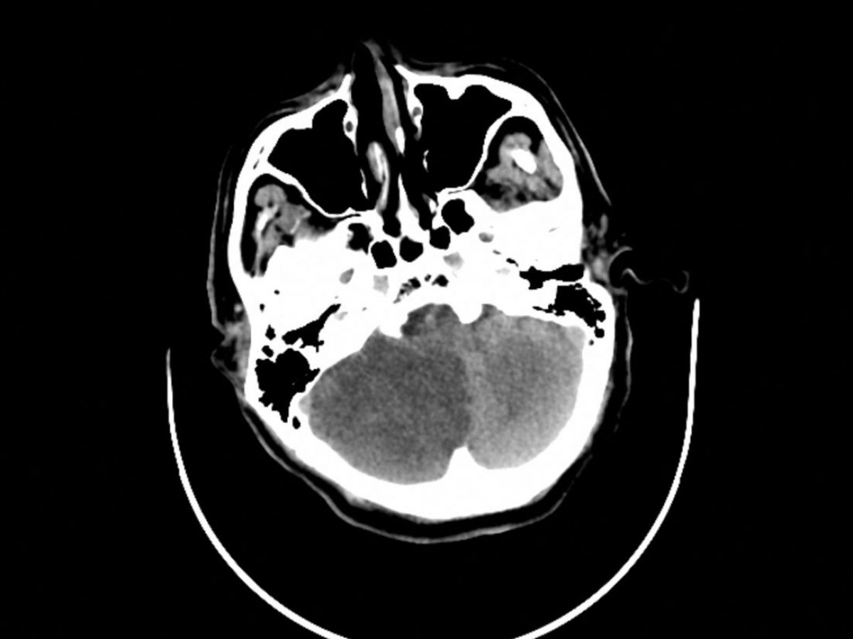 stroke: In France, tens of thousands of victims are poorly treated