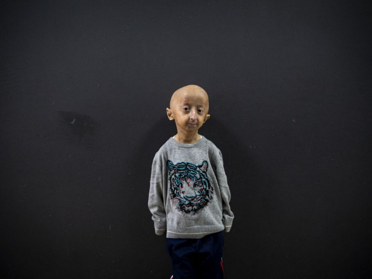 un-gene-de-centenaires-contre-la-progeria