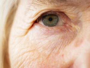 Aging shows in the eyes