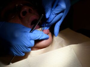 Dental caries: towards reimbursement for four treatments?