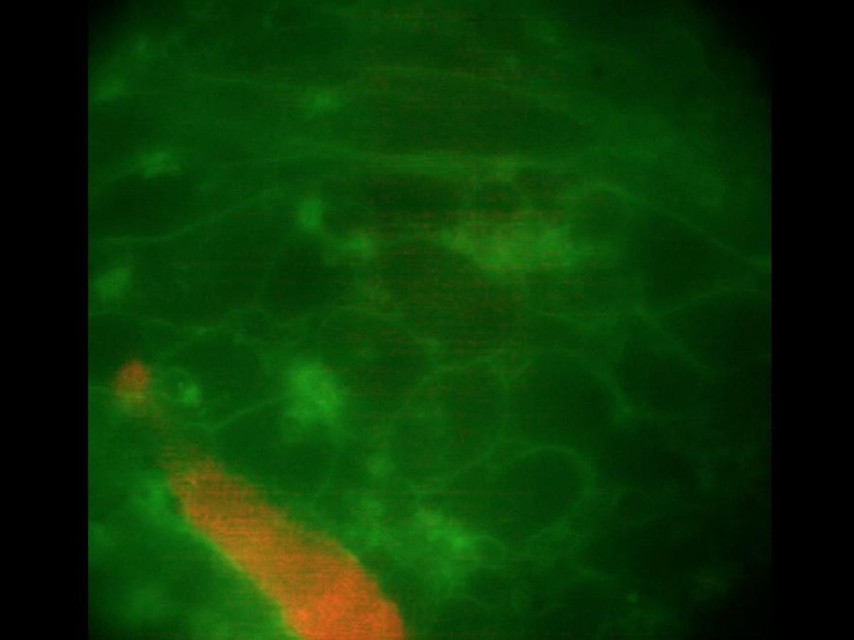 Better understanding atrial fibrillation through heart organoids
