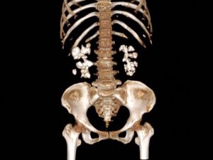 Kidney stones: an unexpected discovery