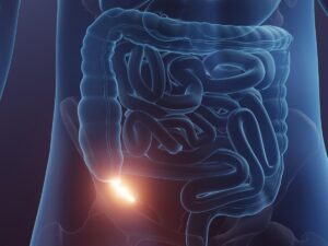 Is appendicitis treated solely with antibiotics effective?