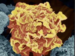 Cancer tested by generative AI