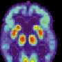 Much-hyped Alzheimer's drugs removed amyloid yet brought no meaningful gains over 18 months