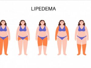 Lipoedema, the "tree-leg disease," is said to affect one in ten women.