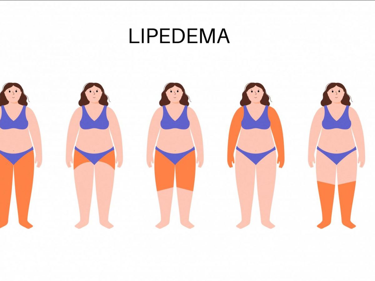 Lipoedema, the "tree-leg disease," is said to affect one in ten women.