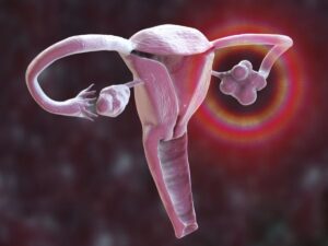 Why is polycystic ovary syndrome changing its name?