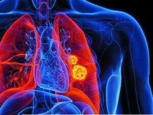 lung cancer screening tests in France