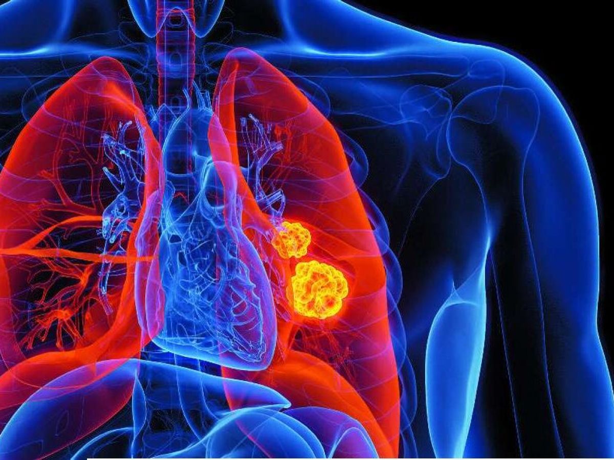 lung cancer screening tests in France