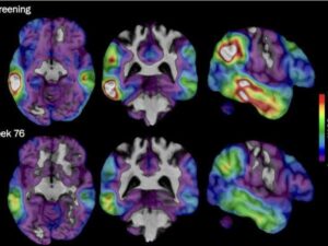 One in two cases of dementia can be prevented or delayed, according to the WHO.