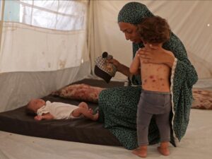 Gaza, a chickenpox outbreak worsens the health crisis
