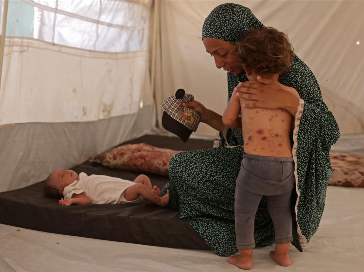 Gaza, a chickenpox outbreak worsens the health crisis