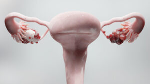 Residential Context Matters in Ovarian Cancer Survival