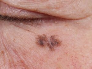 What do you need to know about the mRNA vaccine against melanoma?