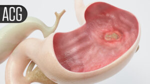 Subcutaneous Risankizumab Induction Improved Outcomes in Crohn's Disease