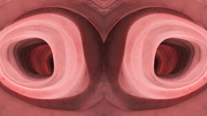 ‘'Constipation' Lands Patient in Surgery for Unusual Anatomy
